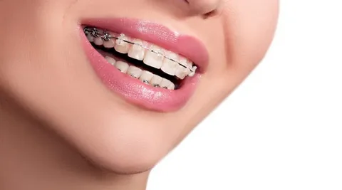 How Self Ligating Braces Are Gaining Attention in Singapore for Faster and Smoother Alignment
